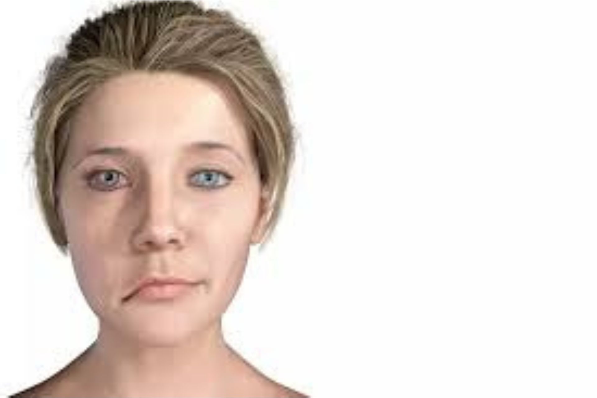 BELL'S / FACIAL PALSY